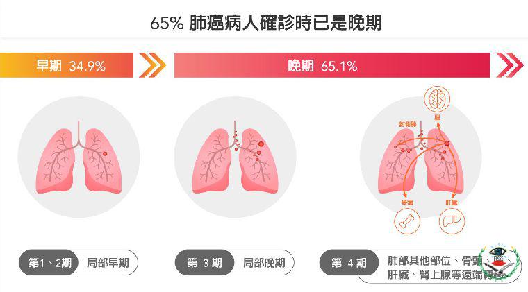 新竹--肺癌晚期不再等於肺癌末期...